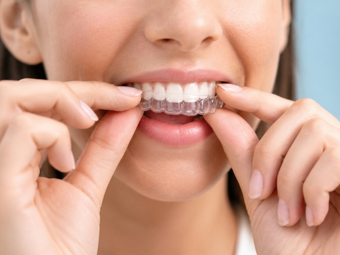 Clear aligner trays