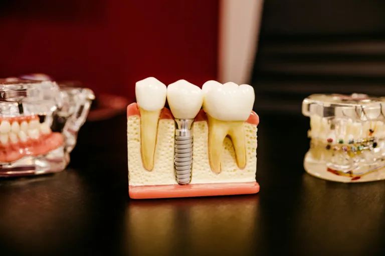 All-on-4 implants