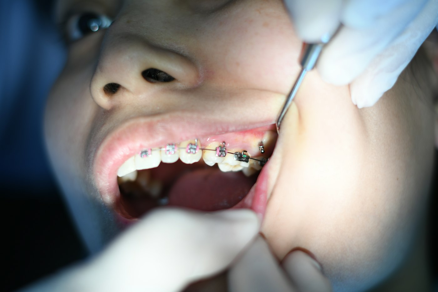 Smiling patient with braces