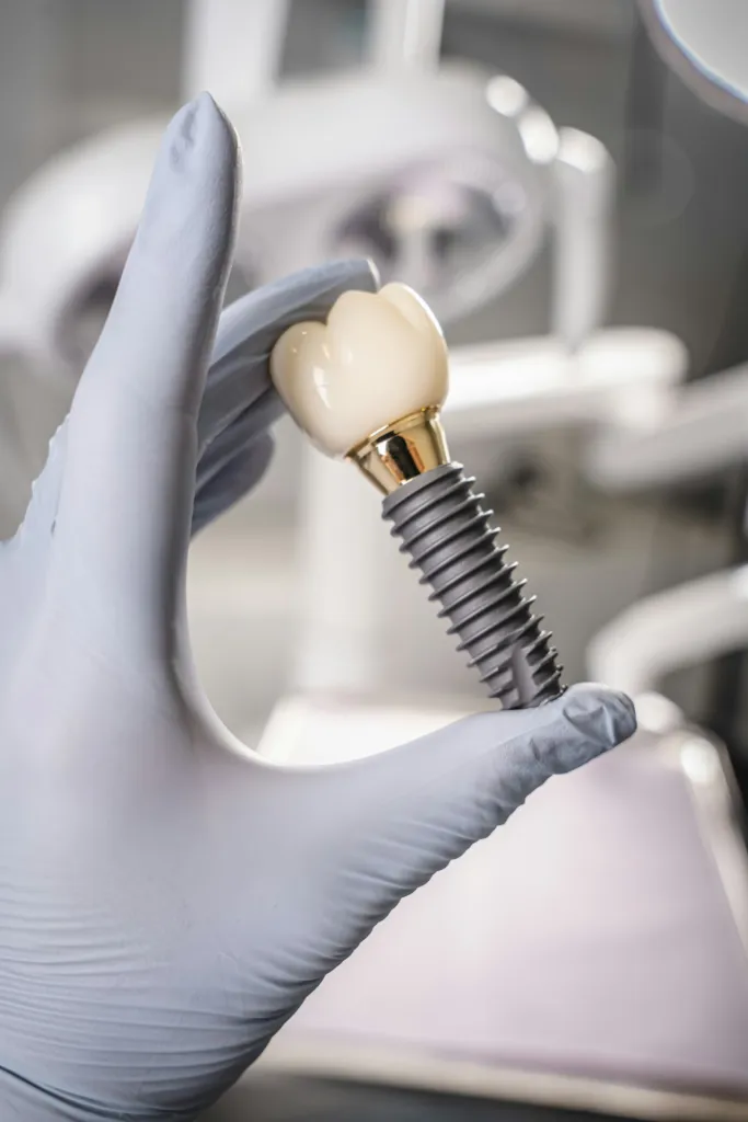 Dental implant model