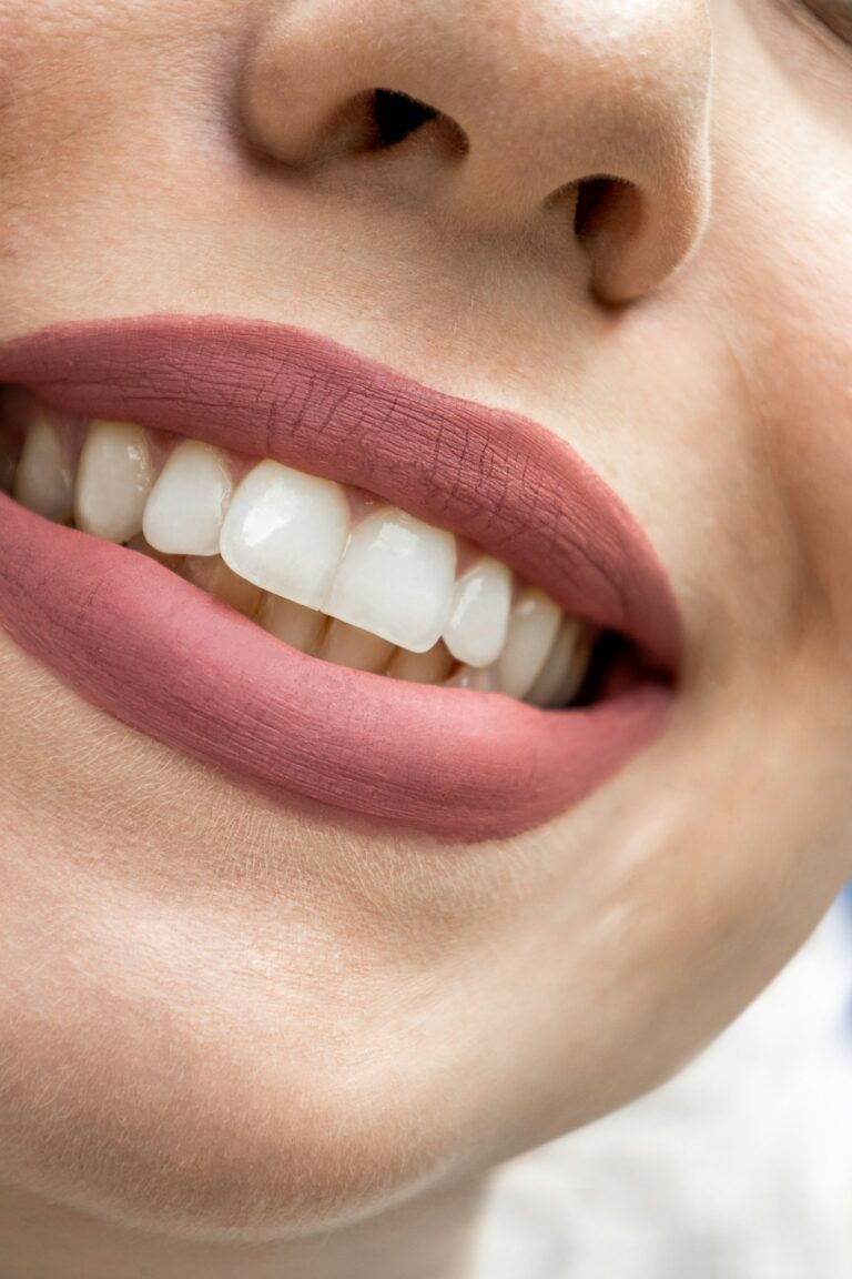 Veneers