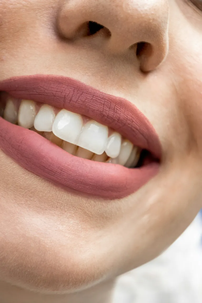 Veneers