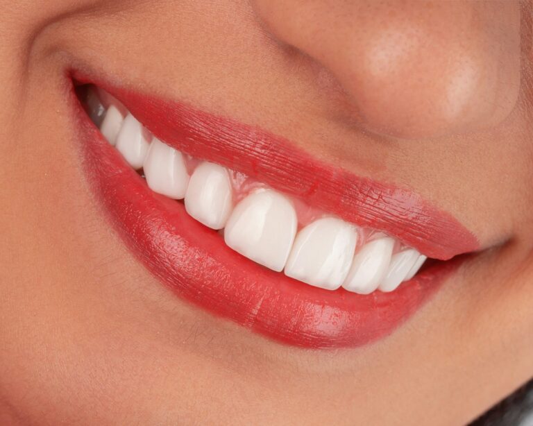 Teeth whitening