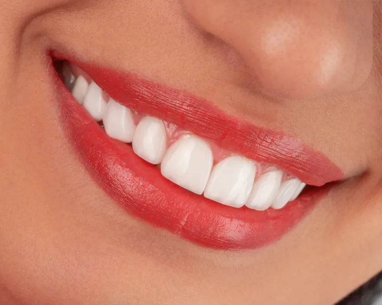 Teeth whitening